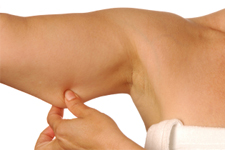 Arm Lift | Brachioplasty | Naples