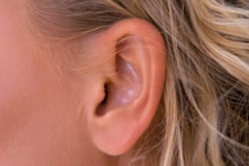 Ear Pinning | Otoplasty | Naples