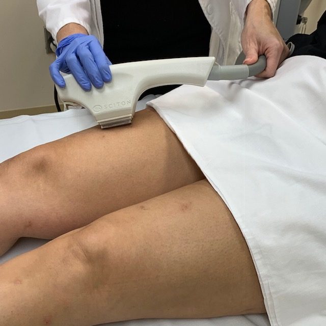 The Sciton BBL can be used on legs to correct sun damage and hyperpigmentation