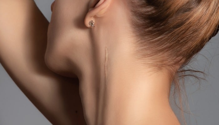 Woman with scar on neck