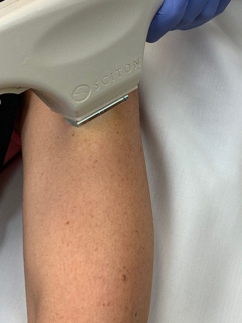 Sciton-BBL-Arm-photo-e1547577436164