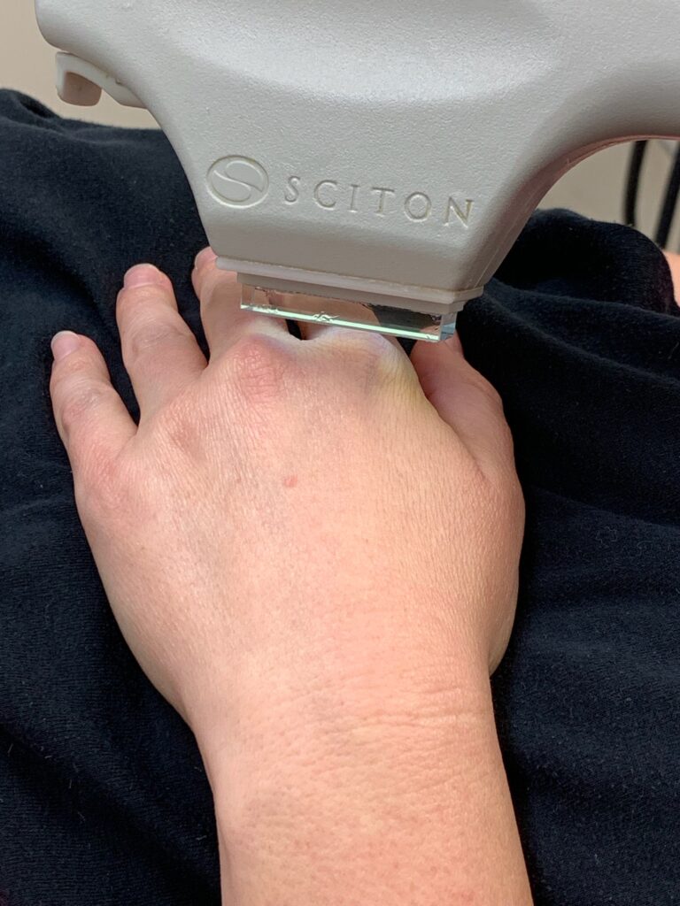 Sciton-BBL-Hand-photo