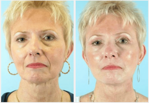 Facelift-Before-and-After-Photos-Naples-FL