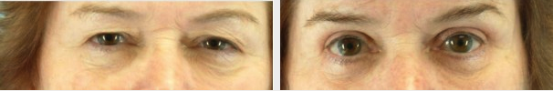 Eyelid Surgery in Naples, FL | Blepharoplasty Surgery | Dr. Andrew Turk