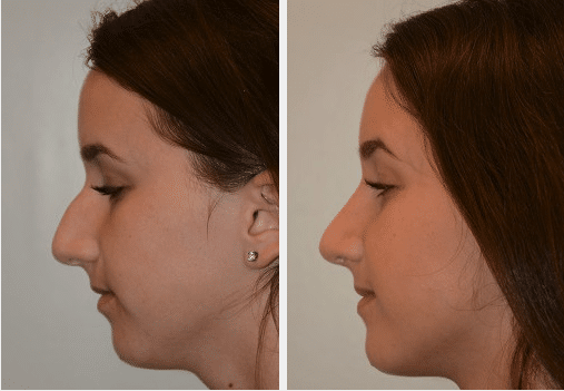 A before and after image of a woman that underwent a rhinoplasty procedure.