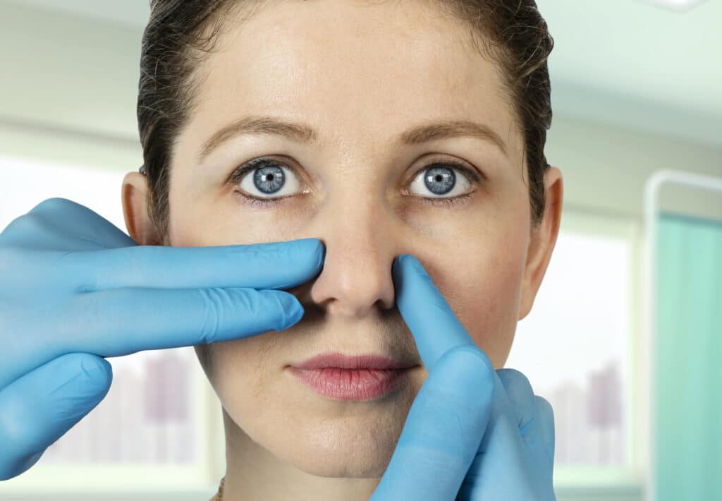 A surgeon pointing at the nostrils of a woman showing wearing the incisions are going to be during a rhinoplasty procedure.