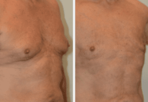Male breast reduction surgery before and after.