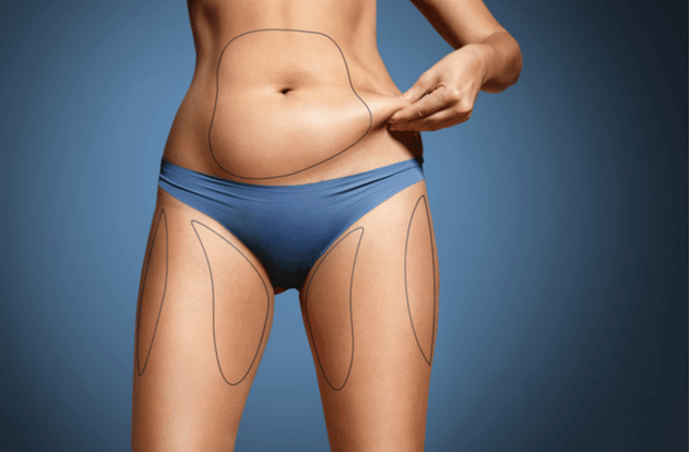 Body with marked zones for liposuction