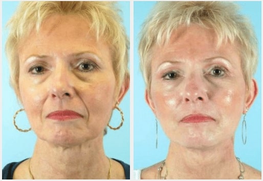 Facelift Before and After Photos Naples FL