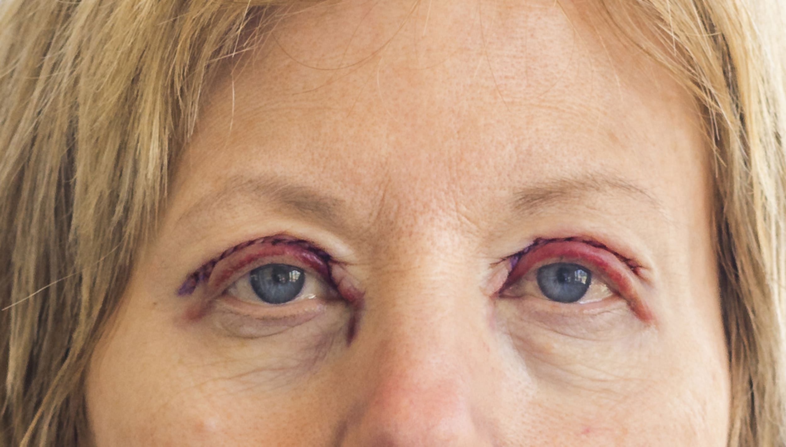 blepharoplasty results