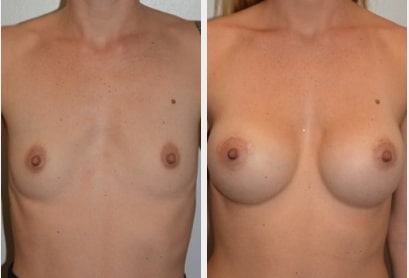 woman’s bare chest before and after breast augmentation with much fuller breasts after procedure