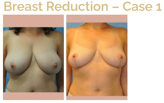 woman’s bare chest before and after breast reduction with smaller breasts after procedure