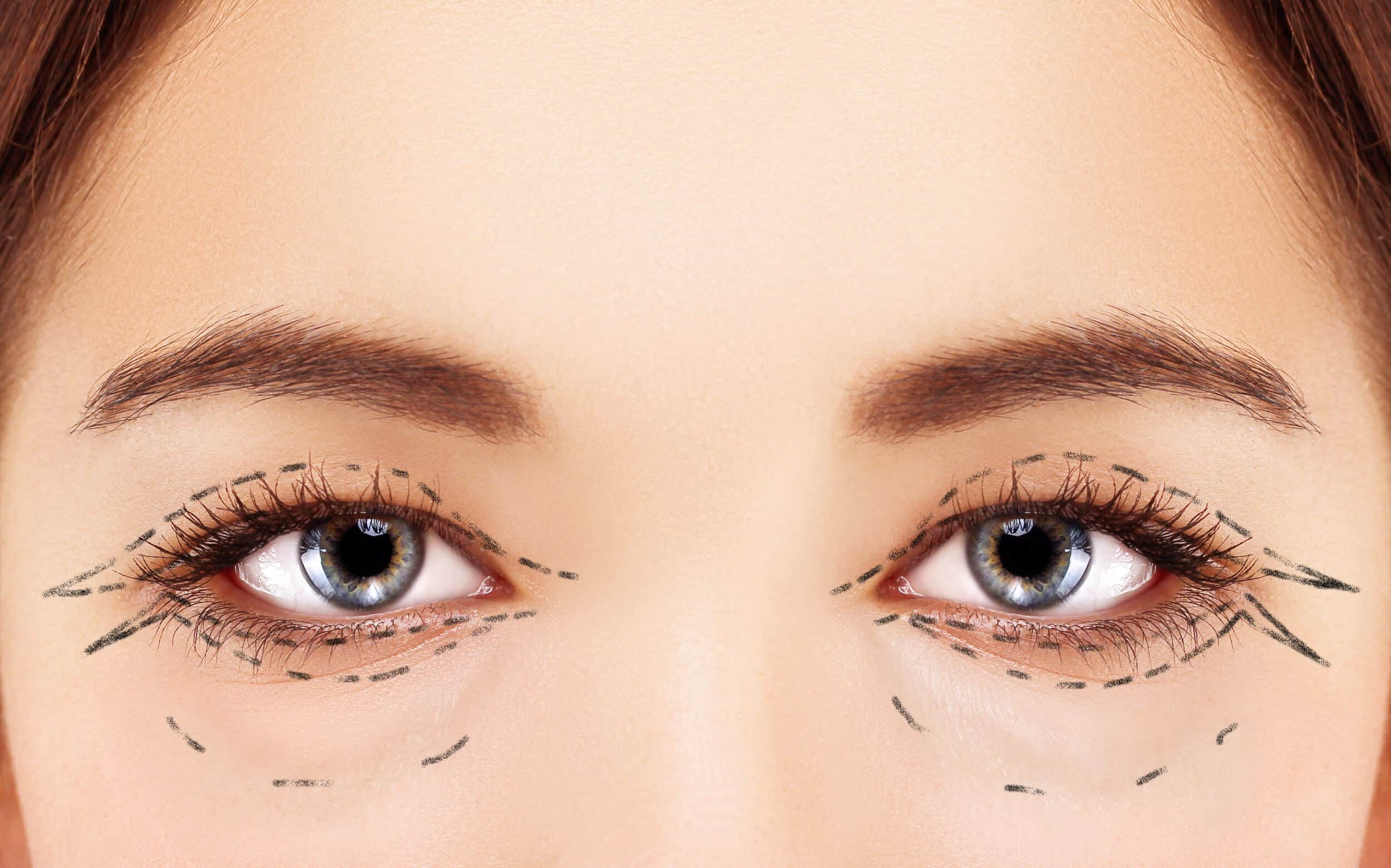 upper blepharoplasty lower blepharoplasty 1