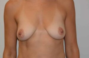 Mastopexy – Case 12