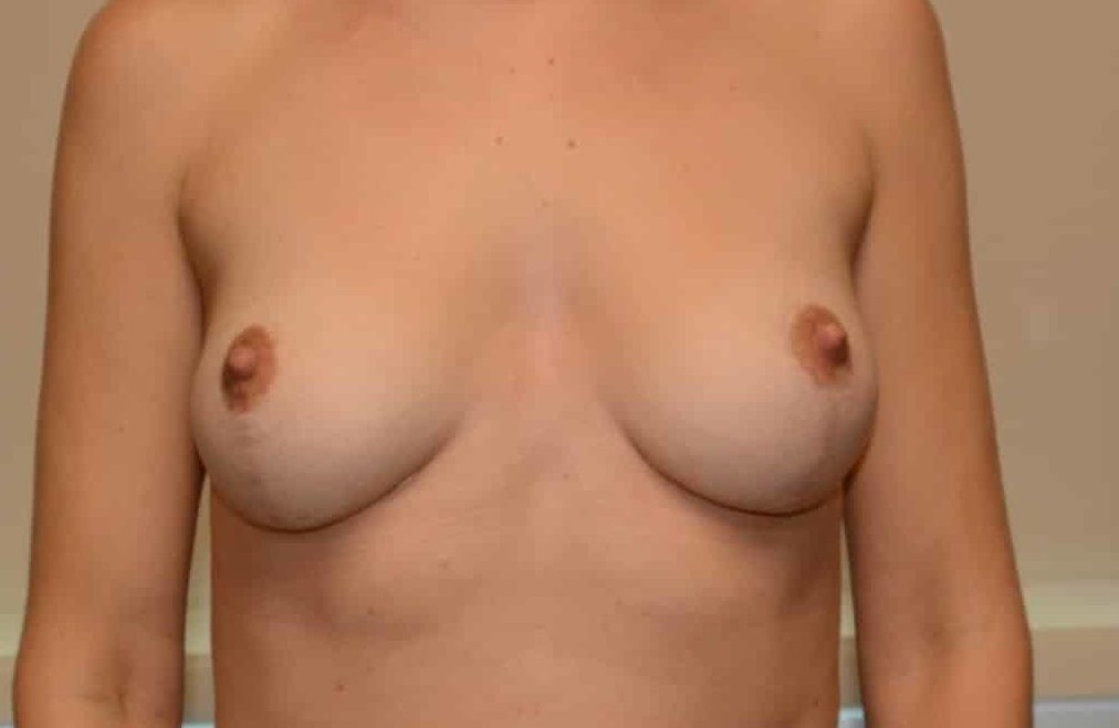 After Image: Mastopexy – Case 12 - front