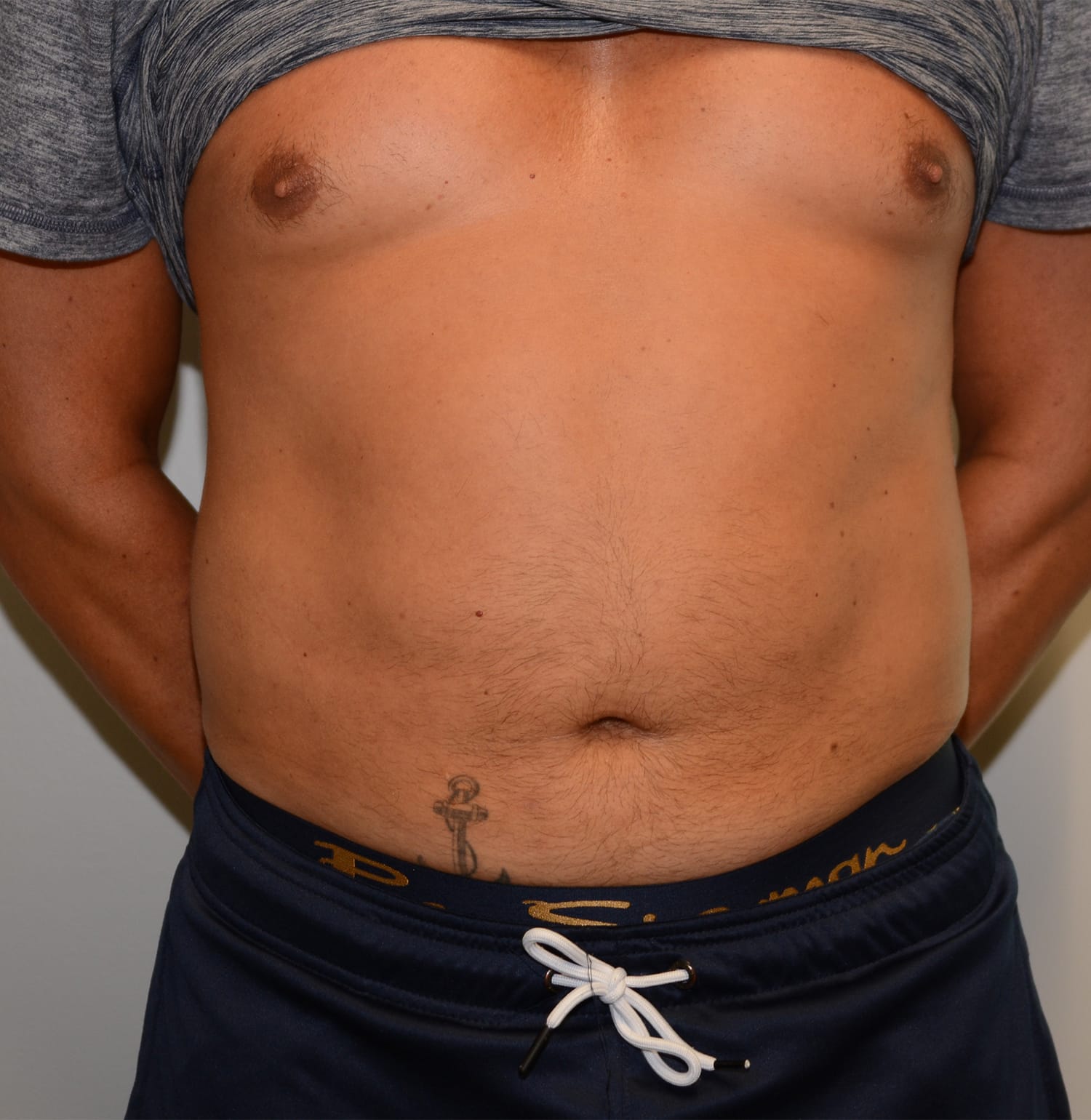 After Image: Liposuction – Case 7 - front