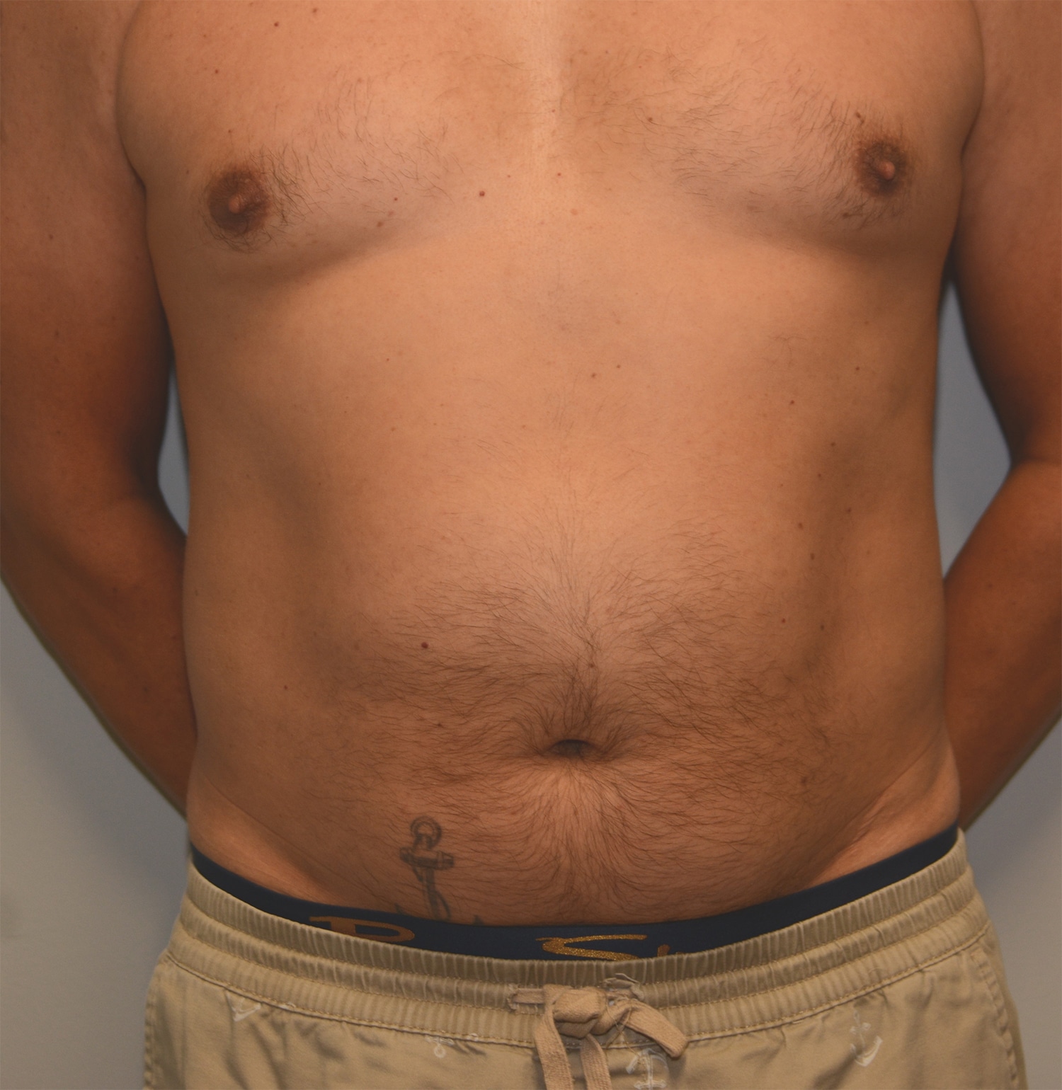 Before Image: Liposuction – Case 7 - front