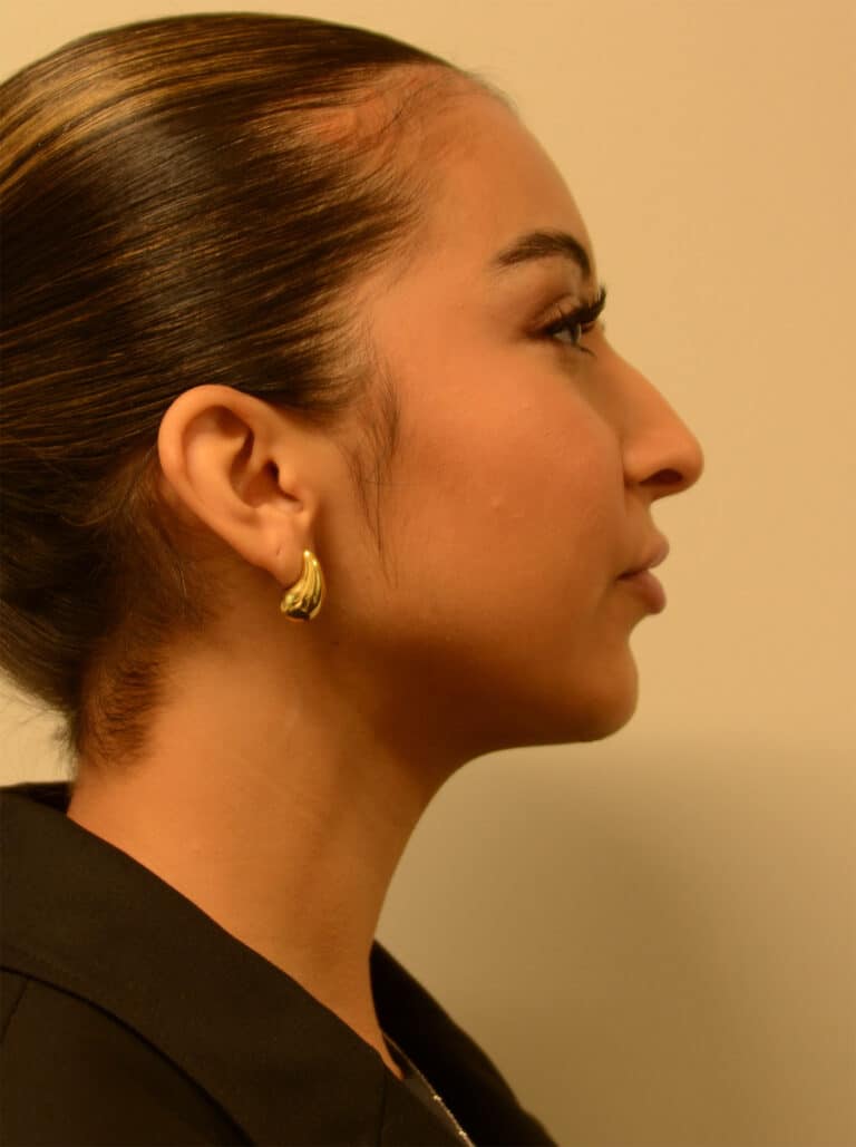 After Image: Rhinoplasty – Case 12 - right-side