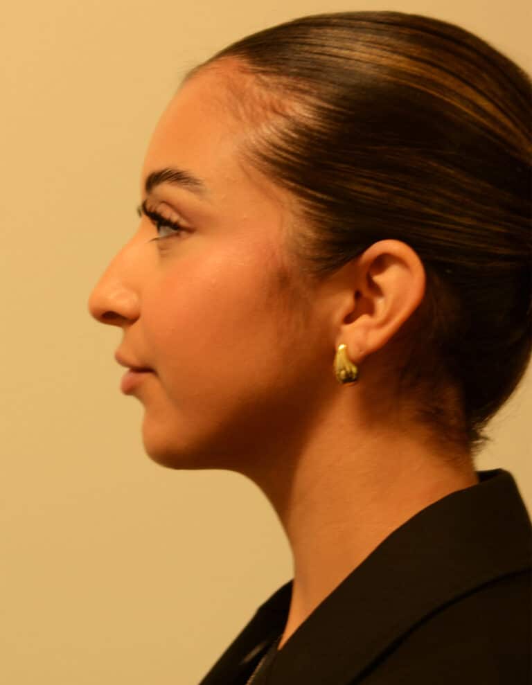 After Image: Rhinoplasty – Case 12 - left-side