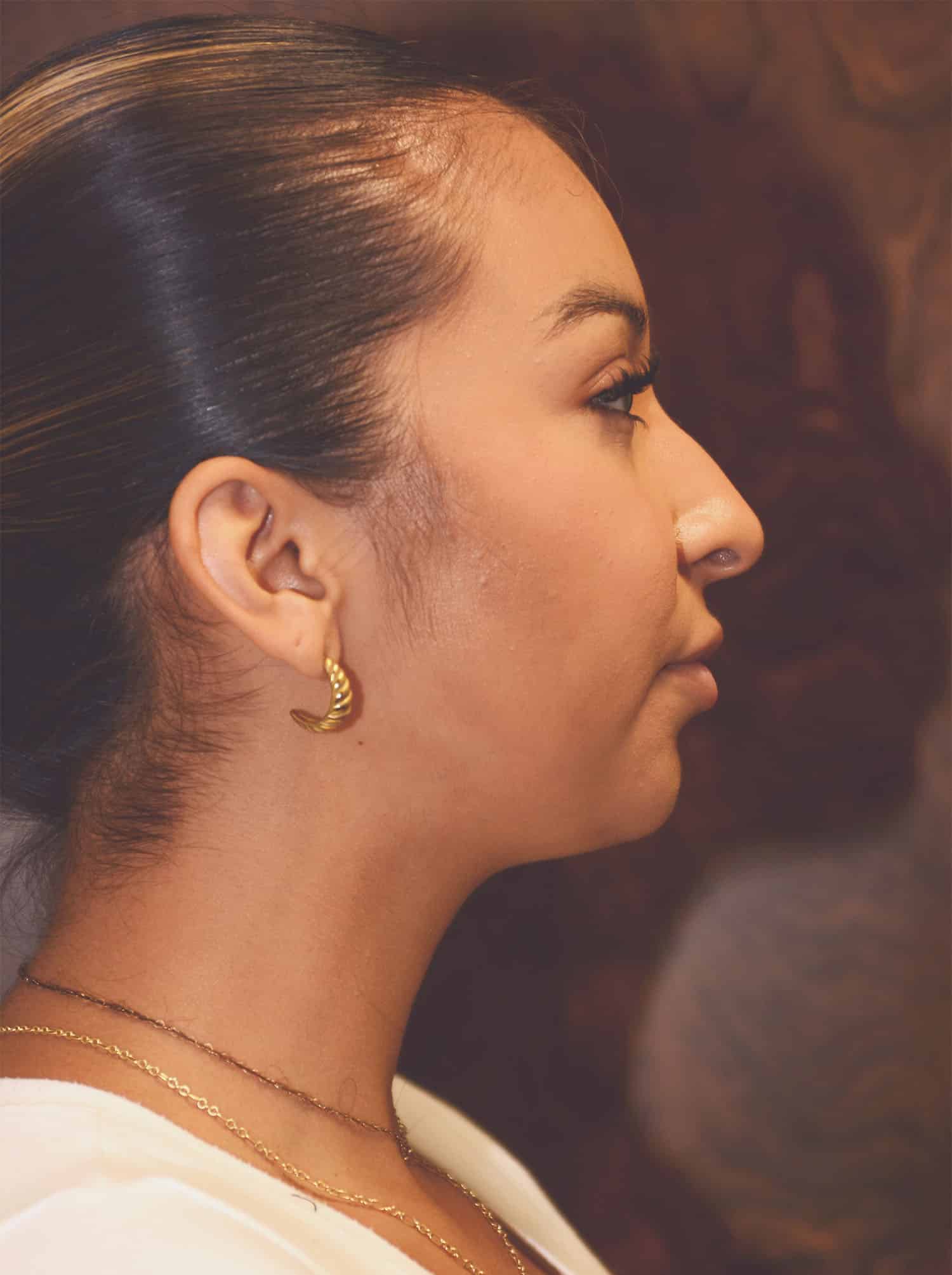 Before Image: Rhinoplasty – Case 12 - right-side