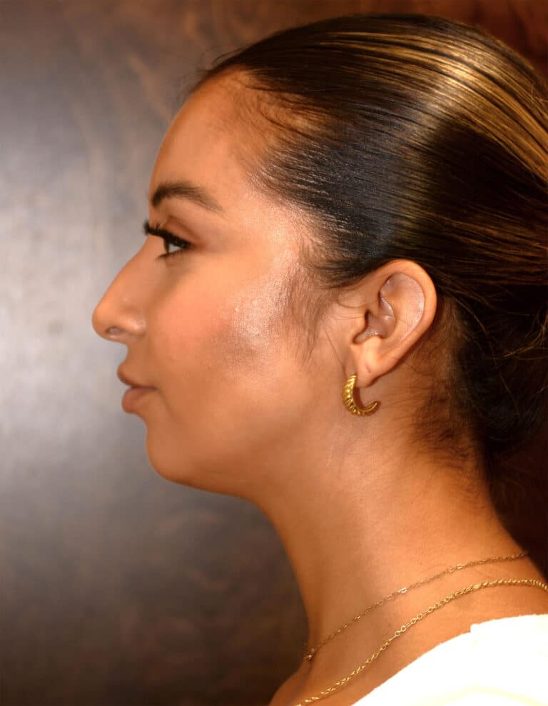 Before Image: Rhinoplasty – Case 12 - left-side