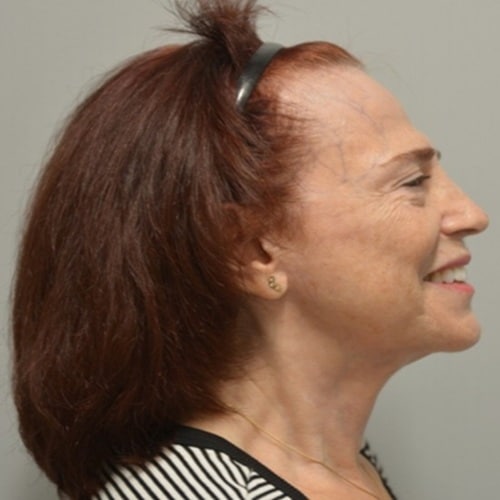 After Image: Necklift – Case 12 - right-side