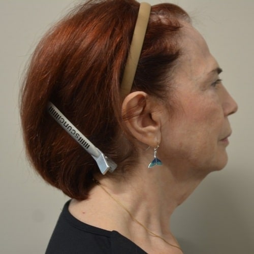 Before Image: Necklift – Case 12 - right-side