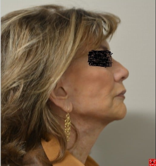 After Image: Necklift – Case 11 - front