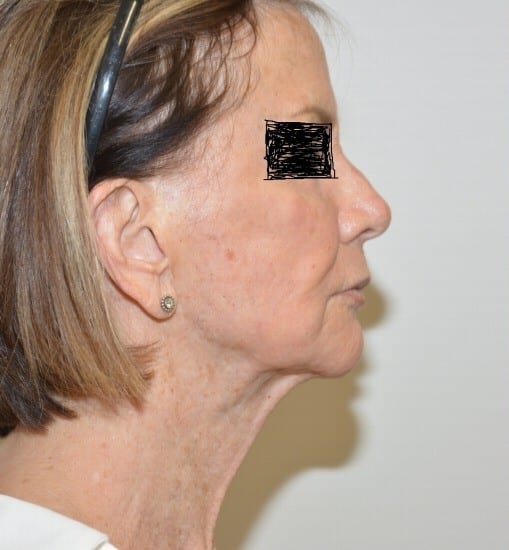 Before Image: Necklift – Case 11 - front