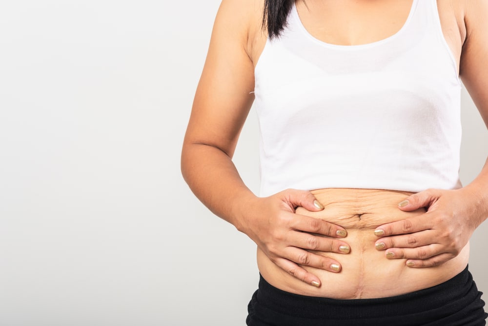 Woman's midsection with loose skin after weight loss before body contouring in Naples, FL