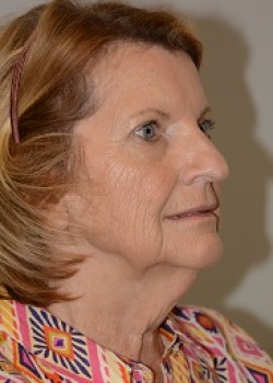 Before Image: FACELIFT- CASE 17 - other