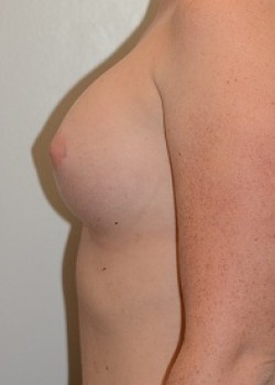 Breast Augmentation – Case 35