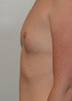 Breast Augmentation – Case 35