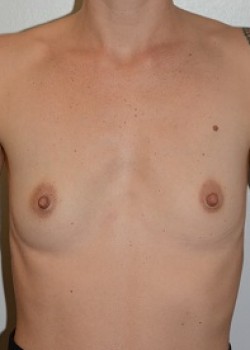 Before Image: Breast Augmentation – Case 36 - front