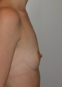 Before Image: Breast Augmentation – Case 36 - other