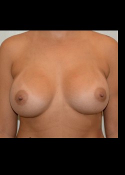 Breast Augmentation – Case 37