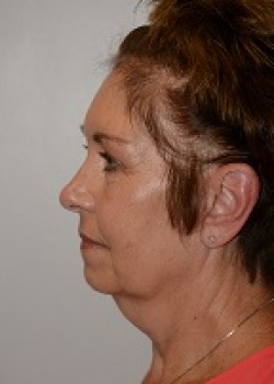Before Image: FACELIFT – CASE 18 - other