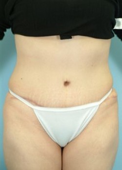 After Image: Abdominoplasty – Case 6 - front