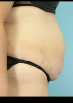 Before Image: Abdominoplasty – Case 6 - other