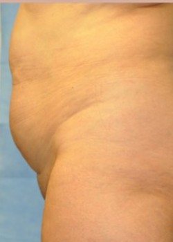 Abdominoplasty – Case 10