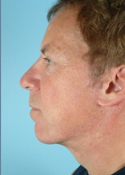 After Image: Chin Implant – Case 4