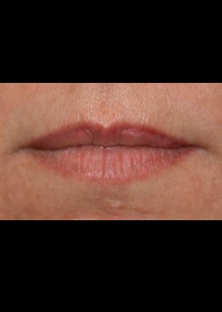 Before Image: Injections – Case 17