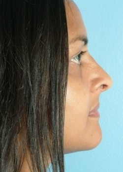 After Image: Rhinoplasty – Case 11 - other