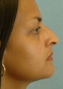 Before Image: Rhinoplasty – Case 11 - other