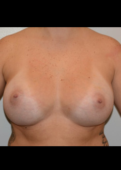 Breast Augmentation – Case 38