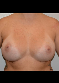 After Image: Breast Augmentation – Case 38 - front