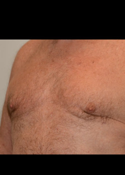 Gynecomastia – Case 3