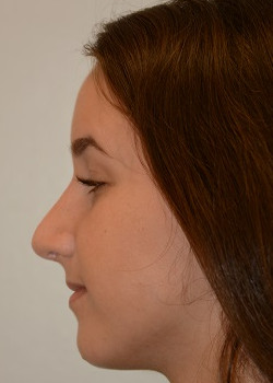 Rhinoplasty – Case 11