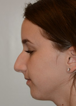 Rhinoplasty – Case 11