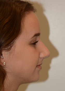 After Image: Rhinoplasty – Case 11 - other
